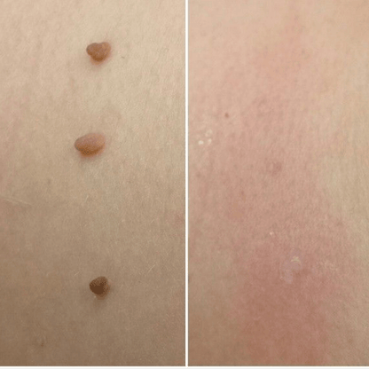 Brivori™ – Elimina acrocordones de forma segura en casa