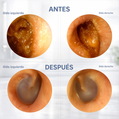 AURILUX™ – Limpiador inteligente para los oídos