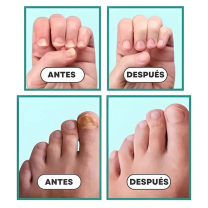 MycoCare™ – Dispositivo anti-hongos para uñas