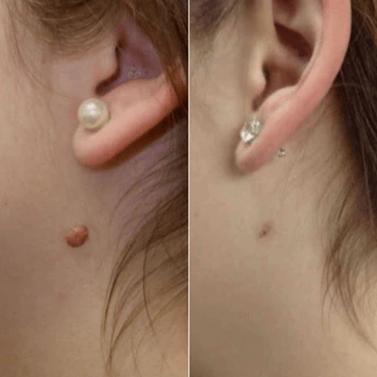 Brivori™ – Elimina acrocordones de forma segura en casa