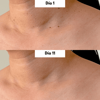 Brivori™ – Elimina acrocordones de forma segura en casa