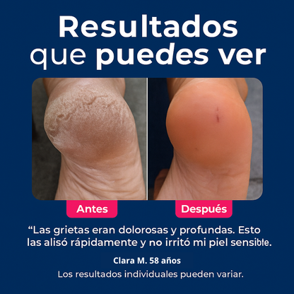 VelaSkin™ - Lima eléctrica para pies