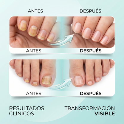MycoCare™ – Dispositivo anti-hongos para uñas